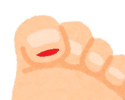 爪切りに失敗して身を切られた親指